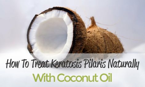 keratosis-pilaris-coconut-oil1-1024x618.jpg